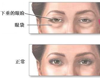 想要永葆青春,显老的眼袋必须割