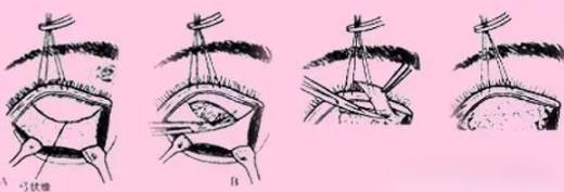 想要永葆青春,显老的眼袋必须割