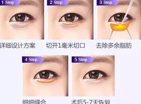 想要永葆青春,显老的眼袋必须割