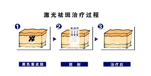 祛斑示意图